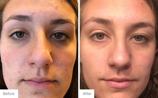 7 - Before and After Real Results photo of a woman's use of Neora's Acne Complexion Treatment Pads