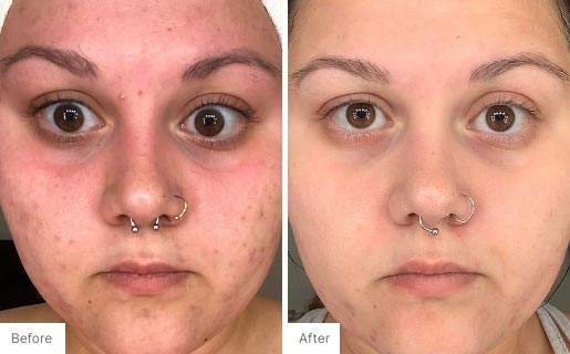 10 - Before and After Real Results photo of a woman's use of Neora's Acne Complexion Treatment Pads
